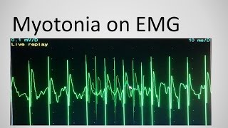 Myotonia on EMG [upl. by Jania]