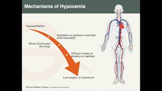 Hypoxemia amp Hypoxia [upl. by Spada]