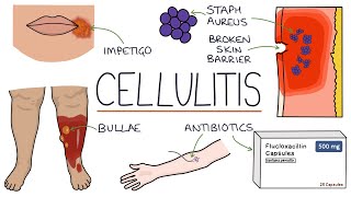 Understanding Cellulitis Skin and Soft Tissue Infections [upl. by Cressida205]