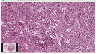 Adenomatoid Tumor  Histopathology [upl. by Gervase]