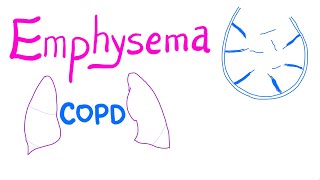 Emphysema  COPD  Pulmonary Medicine [upl. by Nick]