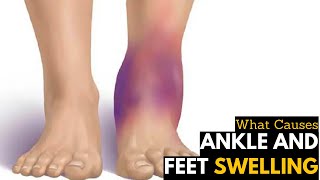 What Causes Ankles amp Feet Swelling  Diagnosis amp Treatment [upl. by Eisned996]