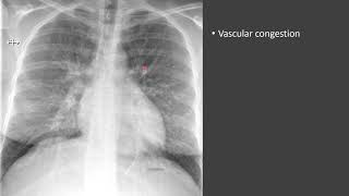 Pulmonary Edema [upl. by Tatman330]