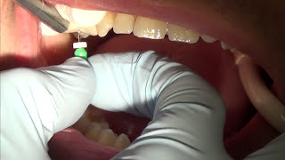 root canal treatment part 1 [upl. by Anse]