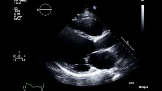 Ischemic Cardiomyopathy 2D Echocardiogram [upl. by Goda]