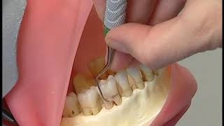 Calculus Removal Stroke [upl. by Einwat]