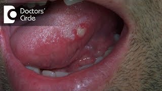 What are different circularlesions present on tongue  Dr Jayaprakash Ittigi [upl. by Akemrej]