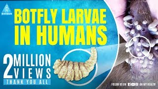 botfly larvae in humans [upl. by Wolfgang]