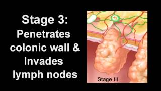 Chemotherapy in Colorectal Cancer [upl. by Pegeen]