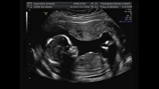 16 Weeks Pregnant Ultrasound [upl. by Isayg]