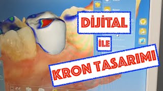 Dijital Ölçü İle Kron Tasarımı [upl. by Ware]