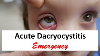 Acute Dacryocystitis Emergency [upl. by Thad]