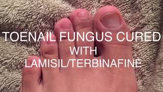 Toenail Fungus BeforeAfter  LamisilTerbinafine 2019 [upl. by Aissila]