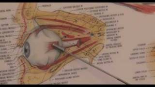 Trabeculectomy Surgery for Glaucoma Animation [upl. by Dody]