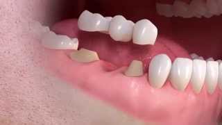 Straumann  Conventional 3unit bridge treatment [upl. by Alfeus]