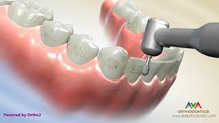 Removing Orthodontic Braces or Debond [upl. by Ddahc]