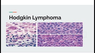 Hodgkin lymphoma [upl. by Luhar343]