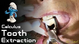 Calculus Tooth Extraction [upl. by Etram]