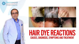 Hair dye reactions  Causes Diagnosis Symptoms and Treatment [upl. by Aicinat]