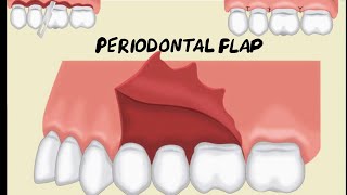 Periodontal Flap [upl. by Enilraep748]