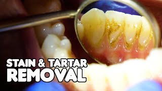 Dental Cleaning EXPLAINED  Stain amp Tartar Removal [upl. by Dine]