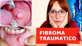 Fibroma Traumático [upl. by Xonel]