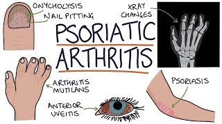 Psoriatic Arthritis [upl. by Broome644]