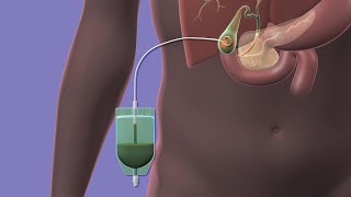 Removal of kidney stones URS [upl. by Euv]