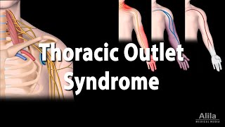 Thoracic Outlet Syndrome TOS Animation [upl. by Akcirred]