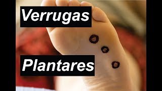 VERRUGAS PLANTARES PAPILOMA VIRUS 🦶 LIMA BLUE 🦶 MEDICINA EXTRAORDINARIA [upl. by Celisse]