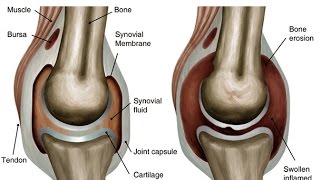 How to Treat a Swollen Knee Home Remedies For Knee Swelling FLUID FILLED KNEE [upl. by Kroy]