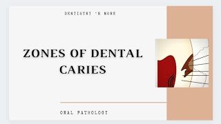 DENTAL CARIES ZONES [upl. by Boehike322]