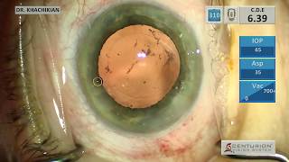 DCR  Tear Drainage Surgery [upl. by Avir585]