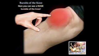 Knee Bursitis  Everything You Need To Know  Dr Nabil Ebraheim [upl. by Diamante80]