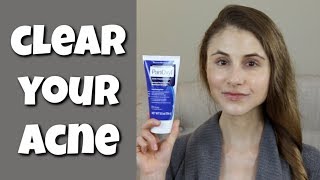 HOW TO CLEAR YOUR SKIN WITH BENZOYL PEROXIDE DR DRAY [upl. by Anelrahs]