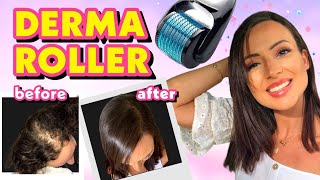 DIY TREATMENT DERMA ROLLER FOR HAIR LOSS  MIRACLE SECRET CURE [upl. by Quiteria6]