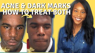 ACNE AND HYPERPIGMENTATION TREATMENT [upl. by Martin908]