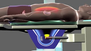 Shockwave Lithotripsy [upl. by Nylzaj]