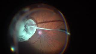 vitrectomy for macular pucker Epiretinal Membrane [upl. by Baer]