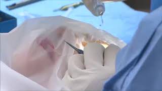 VideoAssisted Thoracoscopic Surgery [upl. by Alahcim]