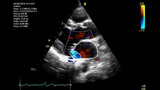 Echocardiographic assessment of the mitral valve [upl. by Bela]