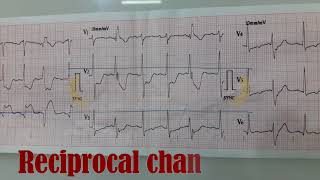 Reciprocal Changes in ECG [upl. by Ynotna]