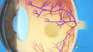 What is branch retinal vein occlusion BRVO [upl. by Ijat262]