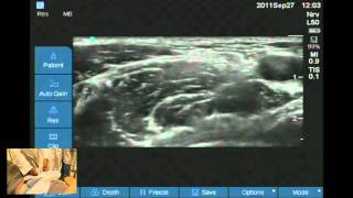 12 Lead Interpretation Part 42 Bundle Branch and Fascicular Blocks [upl. by Iolenta186]