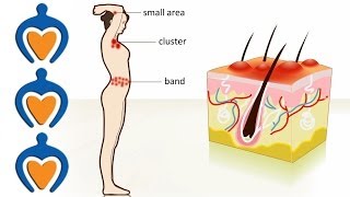 Shingles  The causes symptoms treatment and prevention [upl. by Lombard105]