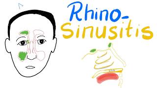 Rhinosinusitis Acuteamp Chronic Clinical Picture Diagnosisamp Management  Cases [upl. by Selinda]