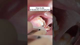 8 Sealants in under 8 Minutes with the Isolite ⏱️ shorts [upl. by Nert]