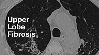 Upper Lung Predominant Fibrosis [upl. by Essa]