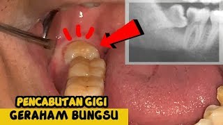 Gigi Geraham Bungsu  Pencabutan  Odontectomy  Dokter Gigi Tri Putra [upl. by Namlaz275]