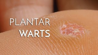 Plantar Warts Verrucas  Podiatrist Georgina Tay East Coast Podiatry [upl. by Hugh]